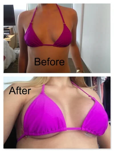 Breast Enhance Mentmicroneedle Patch