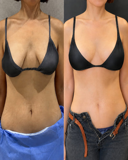 Breast Enhance Mentmicroneedle Patch