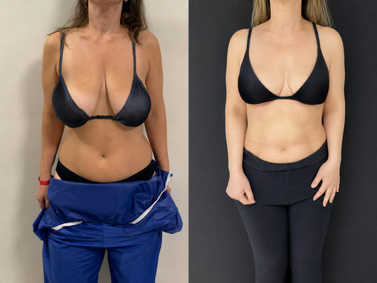 Breast Enhance Mentmicroneedle Patch