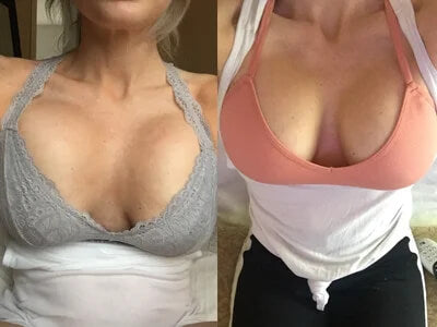 Breast Enhance Mentmicroneedle Patch